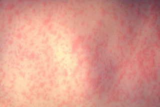 Health Center Offers Measles-Immunity Check; OC Health Care Agency Updates Status