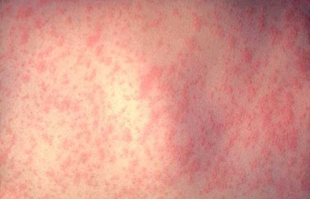 This photograph, from the U.S. Centers for Disease Control, shows the skin of a patient after 3 days of measles infection. Source: http://phil.cdc.gov/phil/details.asp?pid=3168